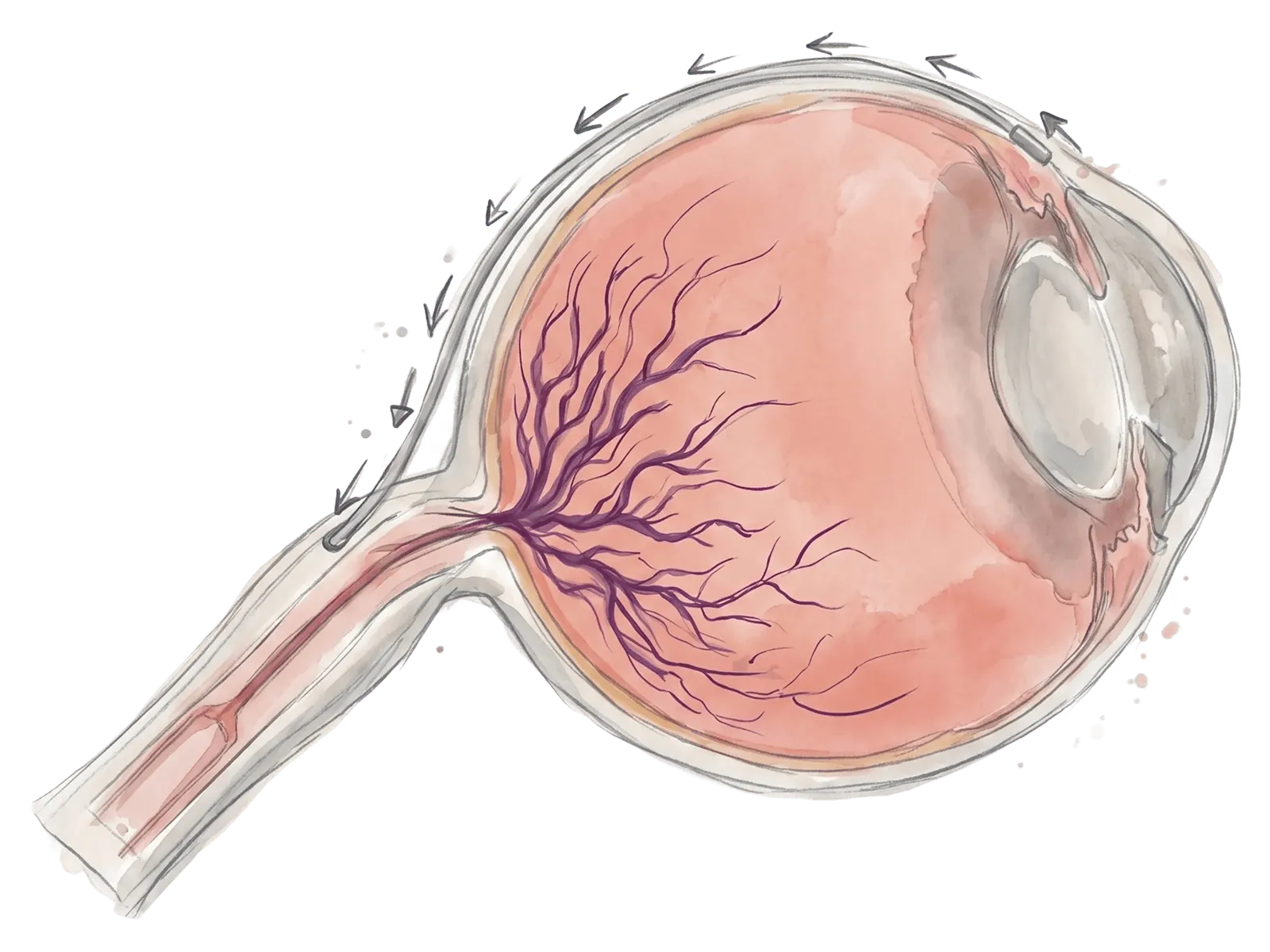 Illustration of QMAX routing fluid to equalize pressure across the optic nerve.