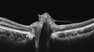 Optic nerve head — IIH-associated bowing